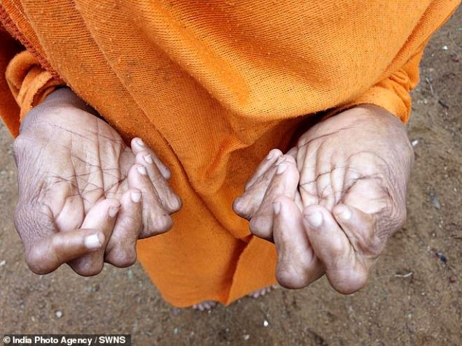 31 barmaqları olan 63 yaşındakı qadına “cadı” elan edildi - FOTOLAR