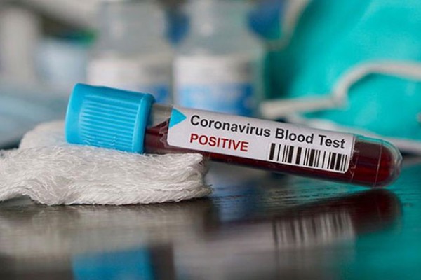 İngiltərədə bir gündə 761 nəfər koronavirusdan öldü