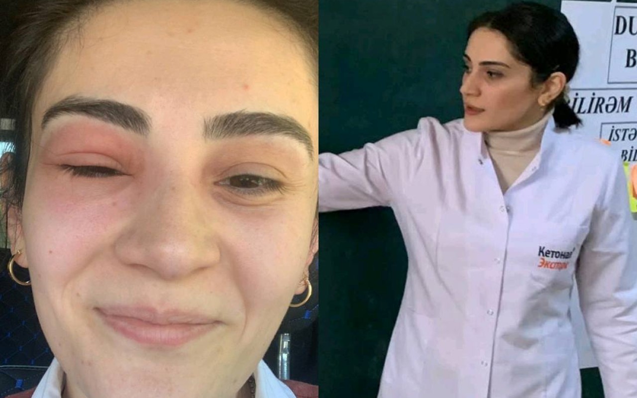 "Tək gözlə imtahandan 55 bal topladım"- Gözünü arı sancan müəllim "Tək gözlə imtahandan 55 bal topladım"- Gözünü arı sancan müəllim